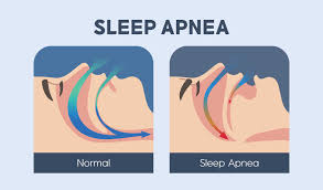 What Is sleep Apnea - TMJ Sleep Apnea