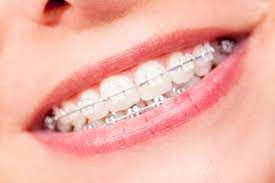 May 17, 2021 · treatment includes your first set of retainers. Keep Your Teeth White With Braces Valderrama Orthodontics