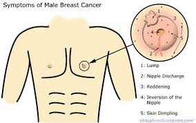 How often are breast lumps cancerous? Male Breast Cancer Is A Pathologists Lancet Kenya Plk Facebook