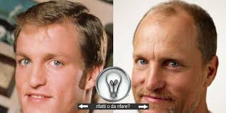 Trapianto di capelli di personaggi famosi e vip italiani. Calvizie Vip Woody Harrelson Rifatti Chirurgia Estetica Vip