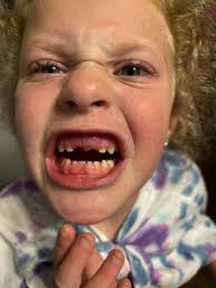 This kid has already lost 3 teeth before any of the other quints lost any  🤣🤣 She's a trip y'all!