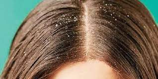 Internal factors that can cause a dry and itchy scalp include: Dandruff Versus Dry Scalp The New Indian Express