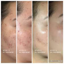 After suffering with painful cystic hormonal acne for a year i decided to go to body brite medical spa for. Wonderlab Ipl Skin Rejuvenation Pigmentation And Vascular Wonderlab Skin Care
