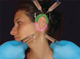 Regional Anesthesia (Nerve Blocks)