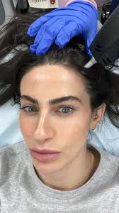 Alma TED Hair Treatment Review and Photos