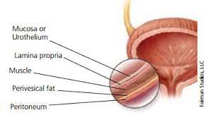 The cancer has spread into the thick muscle. Muscle Invasive Bladder Cancer Symptoms Diagnosis Treatment Urology Care Foundation