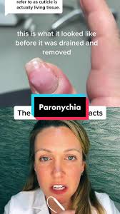 Paronychia