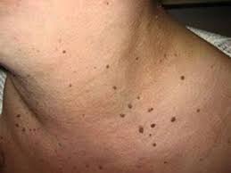 Clinderm Polanco Tienes Verrugas En El Cuello Llamados Tambien Fibromas Blandos O Acrocordones Son Pequenos Tumores De La Piel Que Aparecen Generalmente En El Cuello En Las Axilas Y En Region