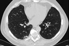 Is Ct Screening For Lung Cancer Cost Effective