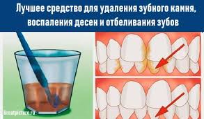 отбеливание зубов в домашних условиях без вреда для эмали Pin Na Doske Recepty
