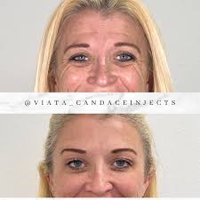 Botox-Katy, Tx| Viata Aesthetics and Wellness| Candace Craioveanu, RN