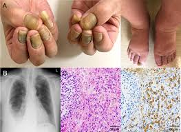 Image result for Yellow nail syndrome feet