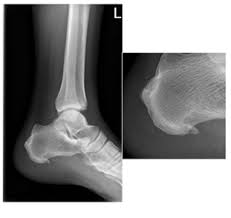 Image result for Calcaneus Compression Fracture