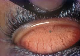 Image result for Conjunctival Foreign Body