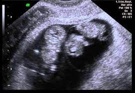 Tengo Gemelitos Bebes De Marzo De 2015 Babycenter