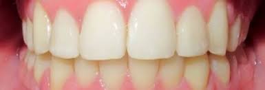 Check spelling or type a new query. Braces Invisalign Expert Richmond Katy Tx Smile Studio Orthodontics