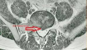 We did not find results for: Herniated Disc Settlements Car Accidents And More