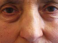 There are different types of tumors, some of which are benign and some of which are cancerous. Rhino Sinusitis Ent Kent