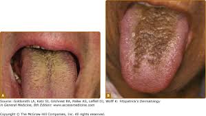 Image result for brown tongue symptoms