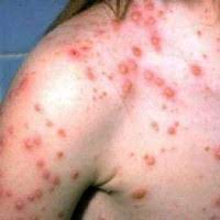 See full list on thediagnosa.com Jangkitan Chicken Pox Semasa Hamil Dr R Juhaidah Blog