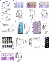 The A-to-I editing of KPC1 promotes intrahepatic cholangiocarcinoma by  attenuating proteasomal processing of NF-κB1 p105 to p50