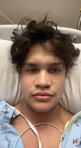 1 day post double jaw surgery ama : r/jawsurgery