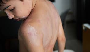 Image result for Atopic eczema atopic dermatitis