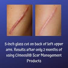 Pin On Cimeosil Scar Management Products
