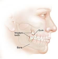 But they have on and off for a year or so. Understanding Wisdom Teeth