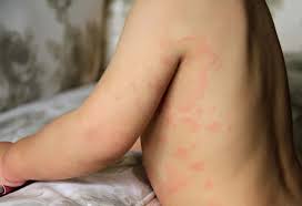 Mottled skin in newborn babies some newborn babies have mottled skin. Skin Discoloration In Babies Causes Home Remedies