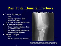 Tennis elbow assessment online course: Fractures And Dislocations About The Elbow In The Pediatric Patient Ppt Download