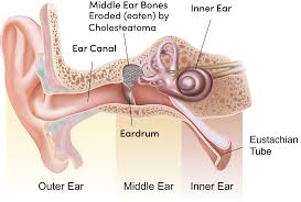 Image result for Inner Ear Decompression Sickness