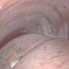 The latent period between exposure and development of the. Pdf Malignant Pleural Mesothelioma An Update On Investigation Diagnosis And Treatment