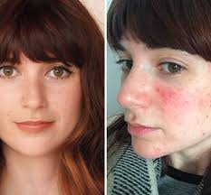 Acne sufferers praise Makeup Revolution’s £9 Conceal and Define foundation  for camouflaging cystic spots and r