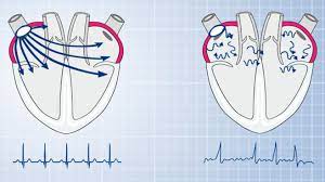 Wenn du hilfe zu ekg geraet fuer zuhause brauchst kannst du uns gerne anschreiben und wir versuchen dir eine antwort zu stellen. Ekg Gerate Im Test Technik Gegen Schlaganfall Computer Bild