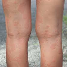 Image result for allergy rash on the legs
