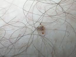 Image result for pubic lice symptoms