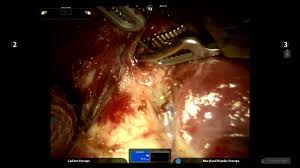 Feeling increasingly out of breath is a common symptom of advanced lung cancer, according to the british lung foundation. Davinci Robotic Pulmonary Lobectomy Advanced Lung Cancer Treatment Vats Youtube