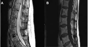 Check spelling or type a new query. Cauda Equina Syndrome In Ankylosing Spondylitis Challenges In Diagnosis Management And Pathogenesis The Journal Of Rheumatology
