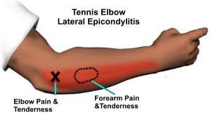 Arms full of tendons, tendons on the forearm. Elbow And Wrist Pain In Rowers Why