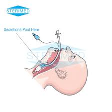 Endotracheal Tube With Subglottic Suction Line Sterimed Group Foley Catheter Medical Supplies Tube