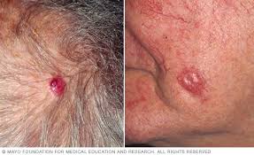 Changes may involve shape, color, or elevation from the skin. Skin Cancer Symptoms And Causes Mayo Clinic