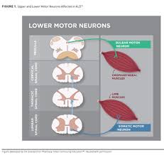 Image result for Progressive Bulbar Paralysis