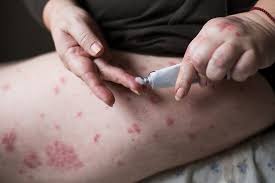 But it's important to consume the right a. Vitamins A And D Not Beneficial In Atopic Dermatitis