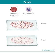 Image result for Anemia
