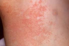 Image result for sweat rash on back baby