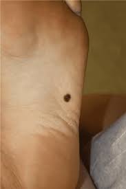Cancer can also cause the immune system to react in ways that produce these signs and symptoms. Skin Cancer And Your Feet Next Step Foot Ankle Clinic