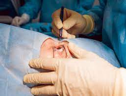 Bei einer operation des grauen stars wird die natürliche linse des auges durch eine. Wie Kann Der Graue Star Therapiert Werden Az Oberland