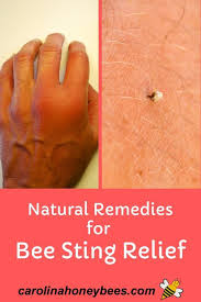 Easy Home Remedies For Bee Stings Carolina Honeybees In 2020 Remedies For Bee Stings Bee Sting Relief Bee Sting Swelling