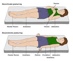 Module 6 Neurological Assessment And Health Promotion At Mount Royal University Studyblue Neurological Assessment Glasgow Coma Scale Nursing Pneumonics
